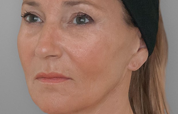 patricia ellanse_after 24 months