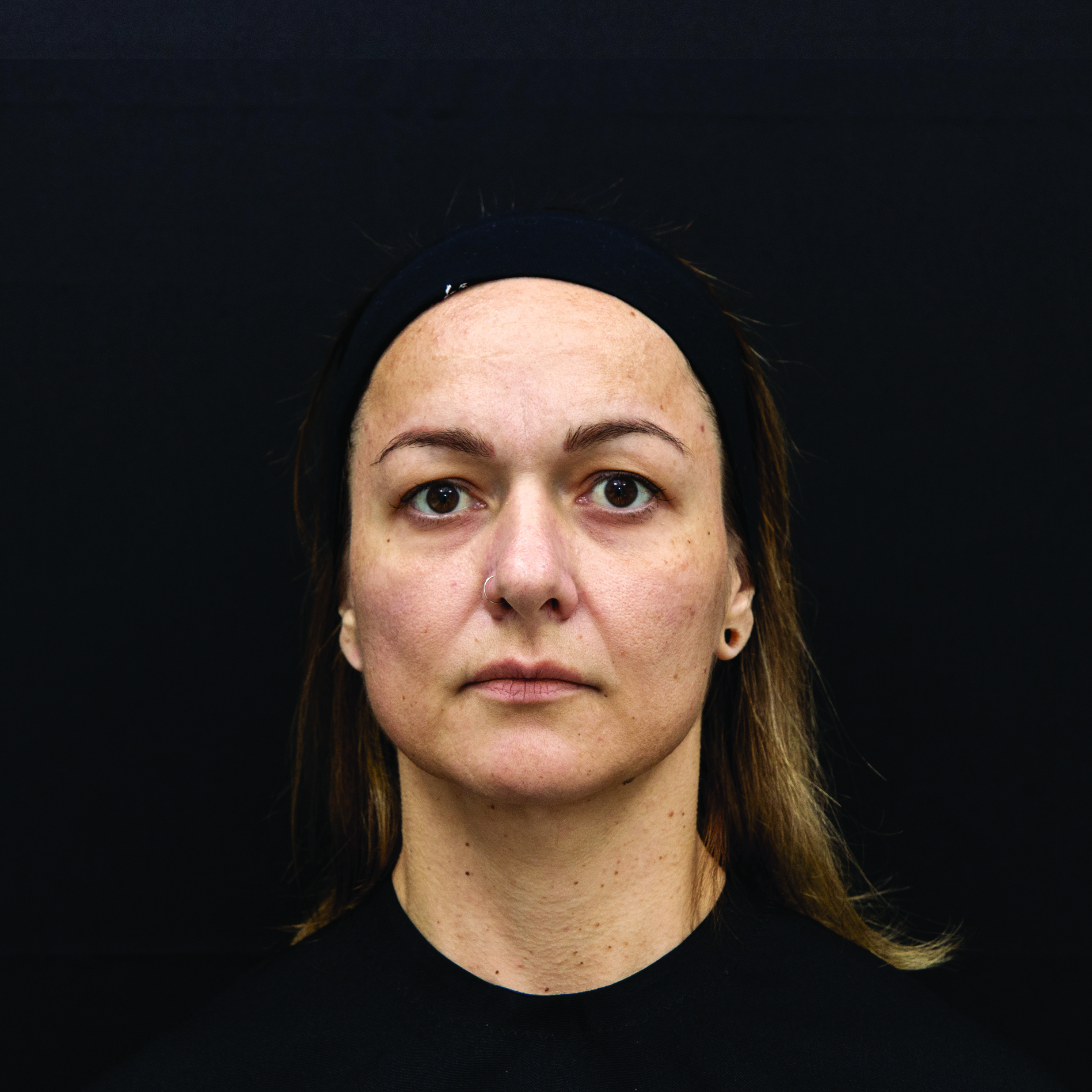 Viviane 3 months after RT